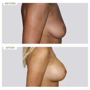 before-after-photo-auxitiki-mastou-enthemta-silikonis-profile-periptwsi-1