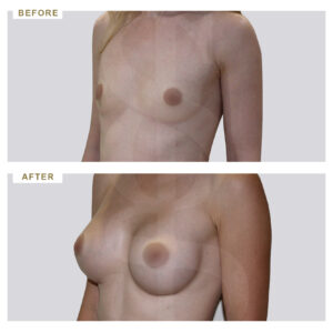 before-after-photo-auxitiki-mastou-enthemta-silikonis-mprosta-opsi-periptwsi-4