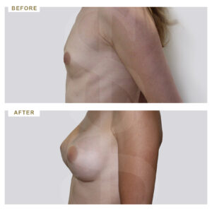 before-after-photo-auxitiki-mastou-enthemta-silikonis-profile-periptwsi-2