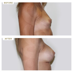 before-after-photo-auxitiki-mastou-enthemta-silikonis-profile-periptwsi-1