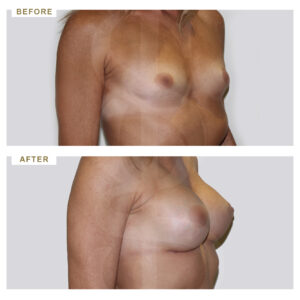 before-after-photo-auxitiki-mastou-enthemta-silikonis-3/4-periptwsi-3