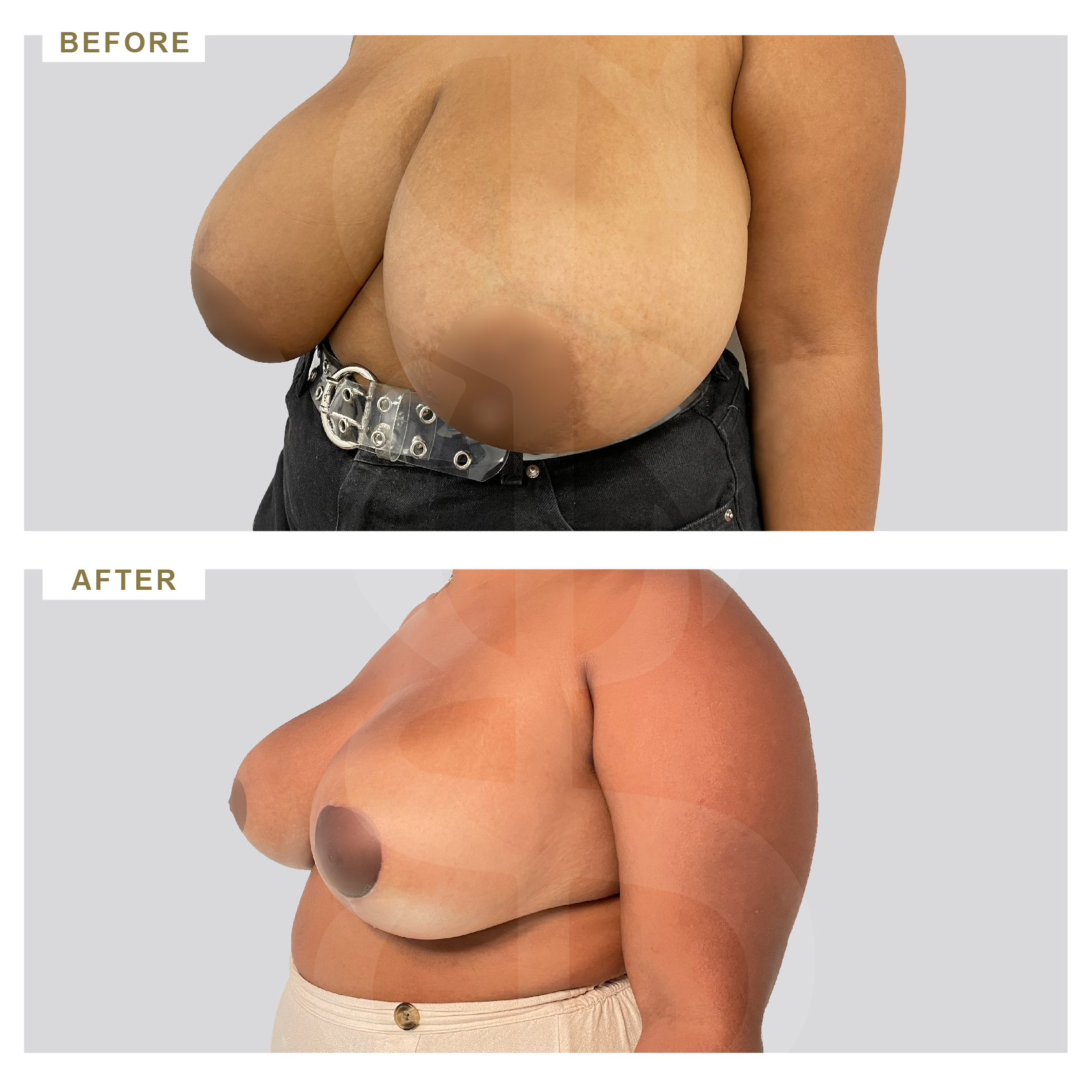 Before and after – Breast reduction – Case 1 – 3/4 view
