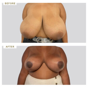 before-after-photo-meiwsi-mastou-mprosta-opsi-periptwsi-1