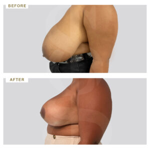 before-after-photo-meiwsi-mastou-profile-periptwsi-1