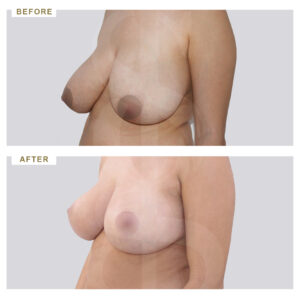 before-after-photo-meiwsi-mastou-3/4-periptwsi-2