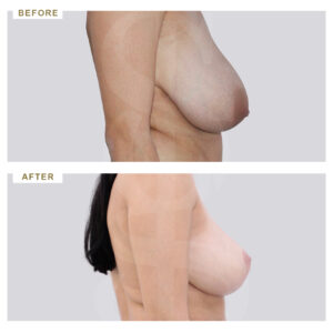 before-after-photo-meiwsi-mastou-profile-periptwsi-2