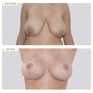 before-after-photo-meiwsi-mastou-mprosta-opsi-periptwsi-2