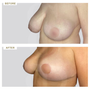 before-after-photo-meiwsi-mastou-3/4-periptwsi-3