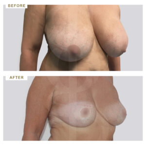 before-after-photo-meiwsi-mastou-3/4-periptwsi-4