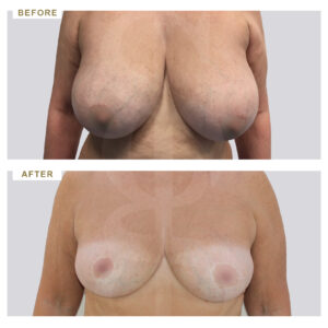 before-after-photo-meiwsi-mastou-mprosta-opsi-periptwsi-4