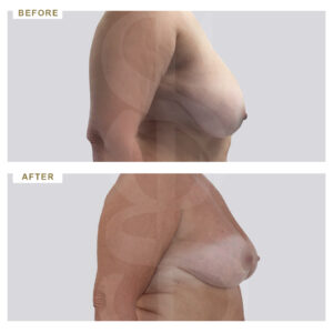 before-after-photo-meiwsi-mastou-profile-periptwsi-4