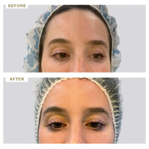 before-after-photo-autologi-therapia-blood-bio-filler-plasma-gel-diorthosi-maurwn-kuklwn-apokatastasi-ogkou-mprosta-opsi-periptwsi-1