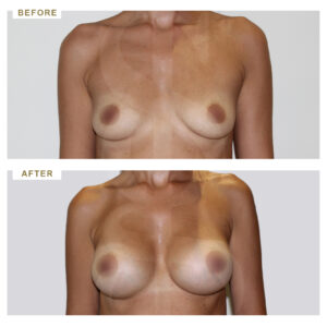 before-after-photo-auxitiki-mastou-enthemta-silikonis-mprosta-opsi-periptwsi-4