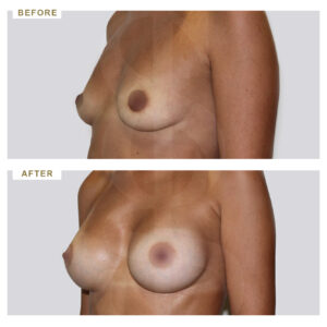 before-after-photo-auxitiki-mastou-enthemta-silikonis-3/4-periptwsi-4