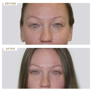 before-after-photo-vlefaroplastiki--mprosta-opsi-periptwsi-1-version-1