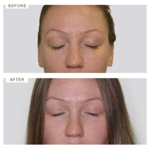 before-after-photo-vlefaroplastiki--mprosta-opsi-periptwsi-1-version-2