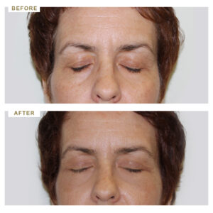 before-after-photo-vlefaroplastiki--mprosta-opsi-periptwsi-2