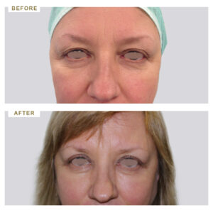 before-after-photo-vlefaroplastiki--mprosta-opsi-periptwsi-3-version-1
