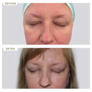 before-after-photo-vlefaroplastiki--mprosta-opsi-periptwsi-3-version-2