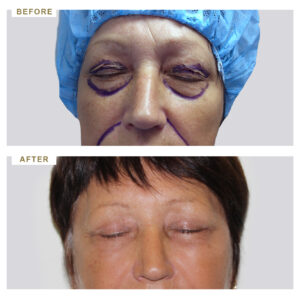 before-after-photo-vlefaroplastiki--mprosta-opsi-periptwsi-4